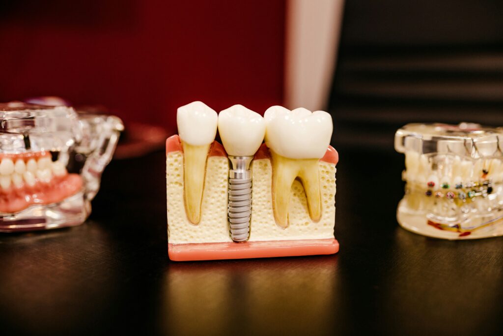 implantes dentales