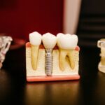 implantes dentales