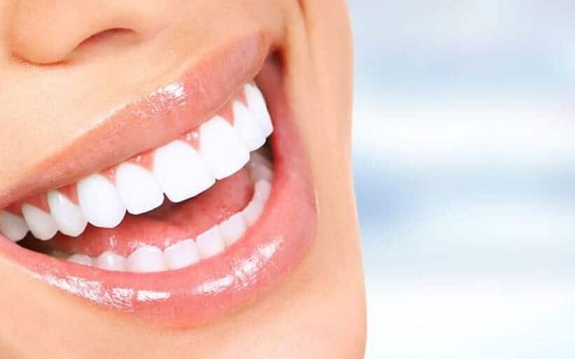 que son las carillas dentales