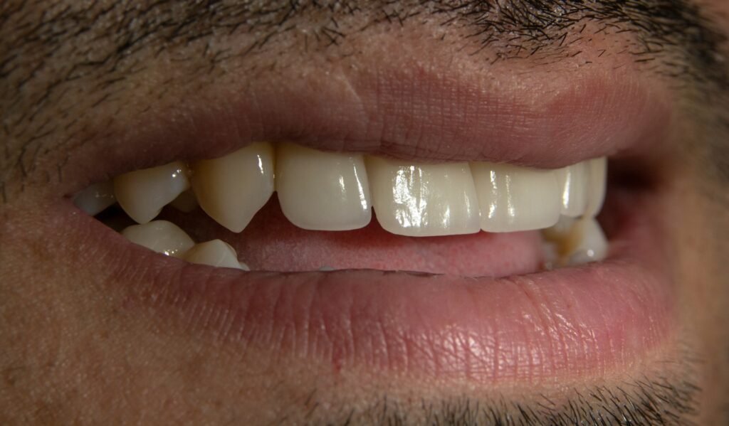 implantes dentales