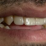 implantes dentales