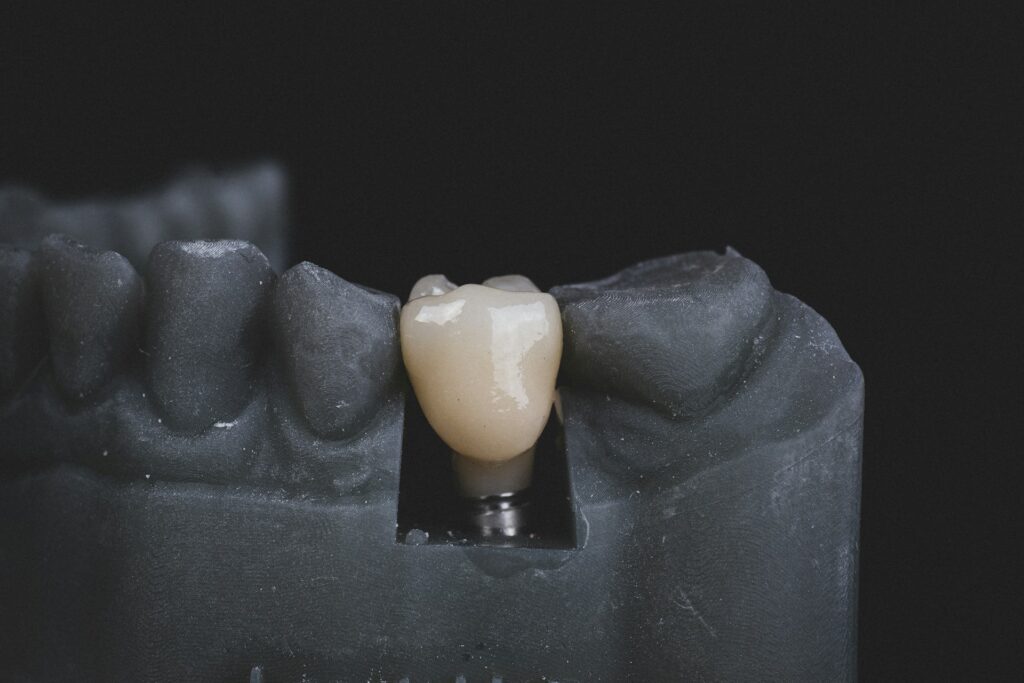 implantes dentales