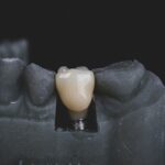 implantes dentales